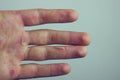 Hands with blister and callus Royalty Free Stock Photo