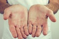 Hands with blister and callus Royalty Free Stock Photo