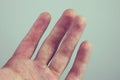 Hands with blister and callus Royalty Free Stock Photo