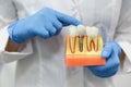 Hands of a dentist doctor hold a model of teeth with a dental implant