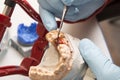 Hands of dentist working on a dental implant