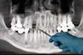 Hands of doctor dentist in gloves show the teeth on x-ray Royalty Free Stock Photo
