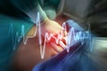 Hands of Doctor perform CPR on a patient in opertion room