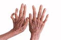 Hands of a leprosy isolated on white background