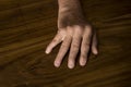 The hands of a male with Psoriatic Arthritis Royalty Free Stock Photo