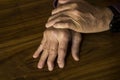 The hands of a male with Psoriatic Arthritis Royalty Free Stock Photo