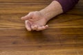 The hands of a male with Psoriatic Arthritis Royalty Free Stock Photo