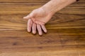 The hands of a male with Psoriatic Arthritis Royalty Free Stock Photo