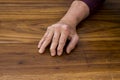 The hands of a male with Psoriatic Arthritis Royalty Free Stock Photo