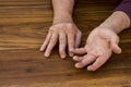 The hands of a male with Psoriatic Arthritis