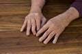 The hands of a male with Psoriatic Arthritis