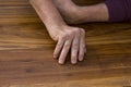 The hands of a male with Psoriatic Arthritis Royalty Free Stock Photo