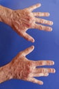 Hands of an man with Dupuytren contracture on blue