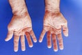 Hands of an man with Dupuytren contracture on blue