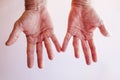 Hands of an man with Dupuytren contracture on bright