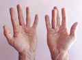 Hands of an man with Dupuytren contracture Royalty Free Stock Photo