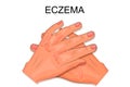 Hands of a patient suffering from eczema