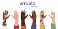 Hands of people with vitiligo are raised up and there is a place for text in the middle. Pigmentation on the hands