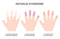 Hands of a person with Raynaud`s phenomenon from white color when blood flow is restricted to blue and red when blood flow return