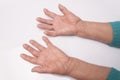 Hands With Rheumatoid Arthritis Royalty Free Stock Photo