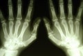 Hands roentgenogram Royalty Free Stock Photo