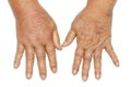 Hands swollen from diabetes