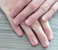 The hands of teenager with burrs on the fingernail. Nibbles fingernail