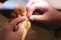 Treatment of a callus on the foot
