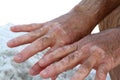 Hands with vitiligo skin condition Royalty Free Stock Photo