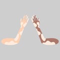 Hands with vitiligo skin disease. concept of supporting people with different body on white background Royalty Free Stock Photo