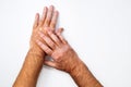 Hands with vitiligo skin pigmentation on white background close-up. Royalty Free Stock Photo