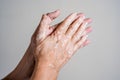 Hands with vitiligo skin problem clapping on isolated background Royalty Free Stock Photo