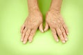 Hands Of Woman Deformed From Rheumatoid Arthritis