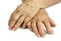 Hands Of Woman Deformed From Rheumatoid Arthritis Royalty Free Stock Photo