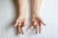 Hands of a woman with twisted fingers. Dupuytren`s contracture disease