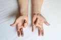 Hands of a woman with twisted fingers. Dupuytren`s contracture disease