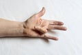 Hands of a woman with twisted fingers. Dupuytren`s contracture disease