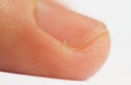 Hangnail Royalty Free Stock Photo