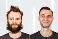 Happy guy with beard and without hair loss. Man before and after shave or transplant. haircut set transformation Royalty Free Stock Photo