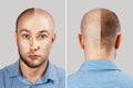 Happy Man before and after hair loss, alopecia. concept of baldness: the first man photo in front, the second - behind Royalty Free Stock Photo