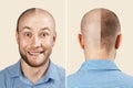 Happy Man before and after hair loss, alopecia. concept of baldness: the first man photo in front, the second - behind Royalty Free Stock Photo