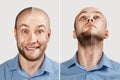 Happy Man before and after hair loss, alopecia. concept of baldness: the first man photo in front, the second - behind Royalty Free Stock Photo