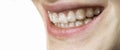 Happy smile of young woman with dental braces aligner