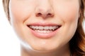 Happy woman`s smile with orthodontic clear braces
