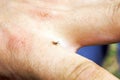 Hard mite, scale tick of family Ixodidae on human hand. Carrier of pathogens that can cause human disease Royalty Free Stock Photo