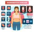 Hashimotos thyroiditis vector illustration. Labeled medical diagram.