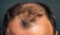 The head of a balding man, the idea of hair transplantation is a surgical method, generated by AI Royalty Free Stock Photo