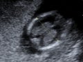 Head of a fetus Royalty Free Stock Photo