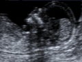 Head of a fetus Royalty Free Stock Photo