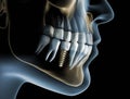 Head and jaw with a dental implant